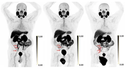 Copper-based radiotracer excels at PSMA imaging