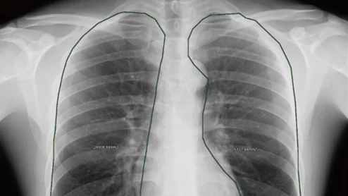Dynamic chest radiography could be an alternative to pulmonary function tests for diagnosing COPD