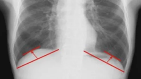Diaphragmatic dome height could inform lung cancer surgery outcomes