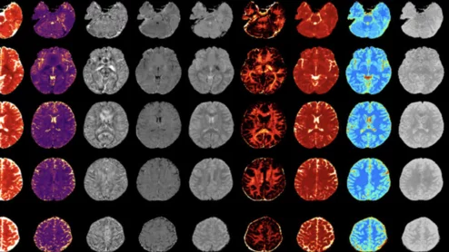 New MRI technique could improve diagnosis and treatment of MS