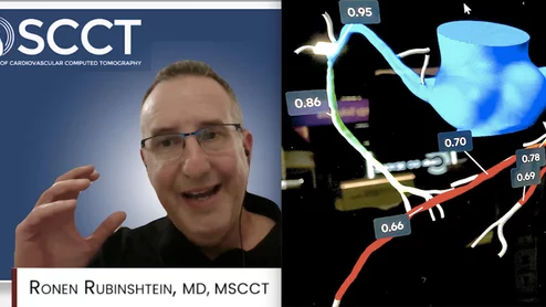 Ronen Rubinshtein, MD, FACC, FESC, director, heart institute, Edith Wolfson Medical Center, in Holon, Israel, president elect for the Society of Cardiovascular Computed Tomography (SCCT), and chairman of the SCCT 2026 annual scientific meeting, explains plaque imaging, AI and structural heart disease are the spotlight at the meeting.