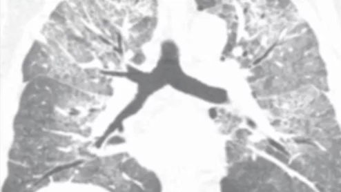 What hantavirus looks like on imaging