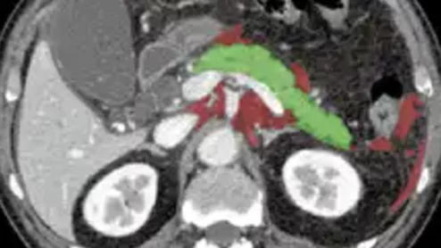AI tool predicts which acute pancreatitis patients are vulnerable to organ failure