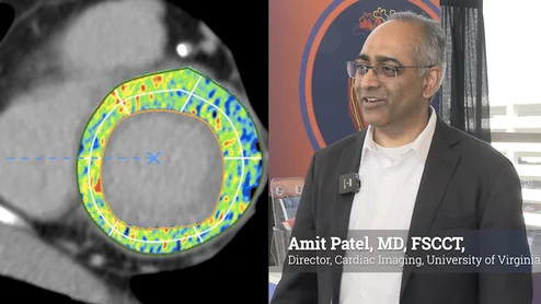 Amit Patel, MD, FSCCT, director of cardiac imaging, and a professor of medicine at the University of Virginia Health System, Charlottesville, explains how extracellular volume (ECV) is being used increasingly in cardiac CT to visualize structural remodeling and conditions like diffuse myocardial fibrosis, amyloidosis, or edema.