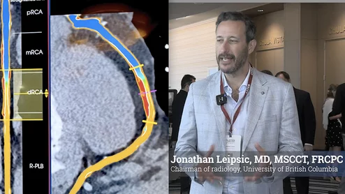 Jonathan Leipsic, MD, MSCCT, FRCPC, chairman of radiology, and a professor of radiology and cardiology, University of British Columbia, Canada, explains some of the key technical developments in coronary CT angiogram (CCTA) plaque imaging, which has seeing rapid adoption. #SCCT #TCT #YesCCT