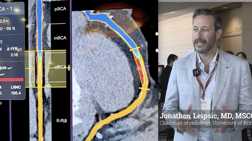 Jonathon Leipsic, MD, MSCCT, FRCPC, chairman of radiology, and a professor of radiology and cardiology, University of British Columbia, Canada, explains some of the key technical developments in coronary CT angiogram (CCTA) plaque imaging, which has seeing rapid adoption. #SCCT #TCT #YesCCT