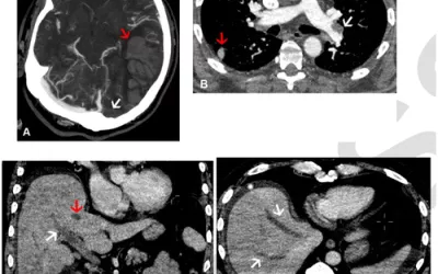 Examples of thrombus formation after COVID-19 vaccinations. While rare, clots in these images were determined to be from the vaccine itself. Images courtesy of RSNA. Blood clots on medical imaging caused by the COVID vaccine. Clinical imaging presentations of COVID. Clinical images of COVID. Medical imaging of COVID-19, SARS-CoV-2. What dose COVID look like on medical imaging? Clinical imaging presentations of COVID. Clinical images of COVID. Medical imaging of COVID-19, SARS-CoV-2. 