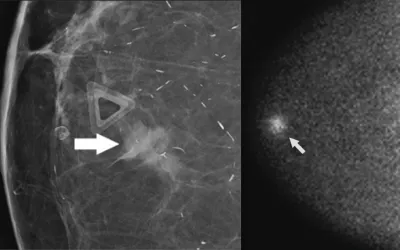 Images from molecular breast imaging (MBI) examinations demonstrating MBI lexicon descriptors. A, Mass (arrow) with marked intensity of uptake. B, Nonmass uptake (arrow) with focal distribution and mild intensity of uptake. C, Nonmass uptake (arrow) with segmental distribution and moderate intensity of uptake. D, Nonmass uptake (arrow) with regional distribution and mild intensity of uptake. Images courtesy of AJR. What does MBI look like? What is molecular breast imaging?