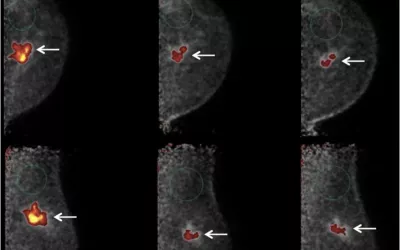 Positron emission mammography (PEM) showing response to primary chemotherapy. This 53-year-old woman presented with lump in left breast, corresponding to 4.3 cm irregular mass on mammography. Ultrasound-guided core biopsy showed grade 3 IDC that was weakly estrogen receptor–positive (<4%), progesterone receptor–negative, and HER2-positive, with axillary node metastasis. (A) Initial PEM craniocaudal (upper) and MLO (lower) 10-min images (day 0) obtained 1 hour after intravenous injection of 370 MBq (10 mCi) 