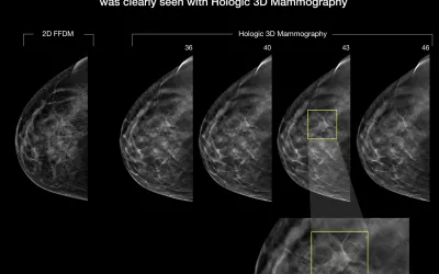 PHOTO GALLERY: What does breast cancer look like on mammography