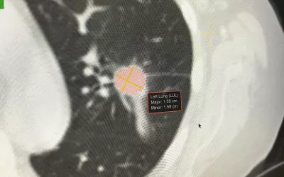 Automated lung cancer detection and contouring by the AI Metrics cancer followup RECIST analysis artificial intelligence. The software is designed to speed serial cancer imaging exams to determine if treatment is working or not. The AI also helps increase consistency in the quantification of the tumor. 