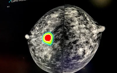 Example of AI for automated breast cancer detection, where the AI highlights an area it believes has an abnormality or patters that match cancers. This example of the Lunit AI is being show in Intelerad's enterprise imaging system as a seamlessly integrated AI tool. #RSNA22 #RSNA