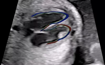 Example of a fetal heart contractility assessment ultrasound on the GE Voluson system. It divides fetal ventricles in 24 segments to simultaneously examine the size, shape and contractility of the fetal heart to help diagnose heart issues and congenital heart disease earlier in fetal development. Congenital heart defects affect 1 in 110 babies born around the world. Image from GE Healthcare. Fetal echo, echocardiogram exam. What is measured on baby ultrasounds, fetal imaging?