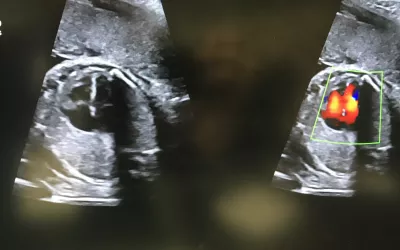 Middle cerebral artery blood flow assessment in the fetal brain using to assess blood flow and fetal hypoxemia. The white outline in the images is the fetal skull. Image courtesy of Alpinion