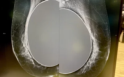 Breast implants on mammography, part of a breast imaging workstation demo in the Sectra booth at HIMSS23.