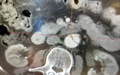 Aortic aneurysm on CT, Sectra HIMSS23.