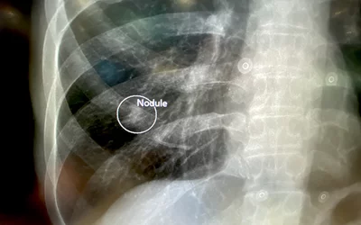 Automated AI lung nodule detection, Sectra PACS at HIMSS23.