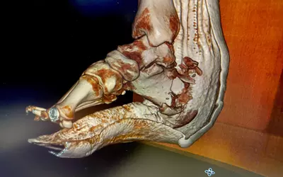 Shattered foot CT 3D reconstruction, Sectra PACS at HIMS23.