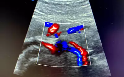 New-look 3D Doppler blood flow using the the Philips Epiq ultrasound system at RSNA 2023. Photo by Dave Fornell #RSNA #RSNA23 #RSNA2023