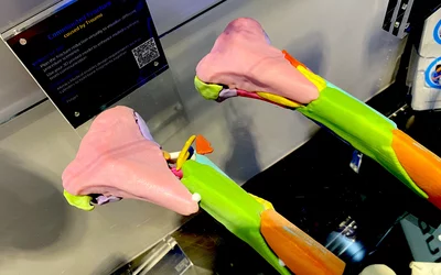  3D printed fracture of both femurs from CT scan to aid reconstructive orthopedic surgery, displayed by Materialise at RSNA 2023. DF#RSNA #RSNA23 #RSNA2024