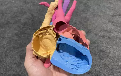  3D printed congenital single ventricle patient from CT Medviso. Models like this can help in sugical preplanning and peri-procedural guidance.#RSNA #RSNA23 #RSNA2024