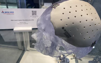 3D printed PEEK cranial implant. Photo by Dave Fornell. #RSNA #RSNA23 #RSNA2023