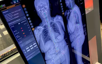 AI automated orthopedic measurements on the EOS load bearing X-ray system at RSNA 2023. Photo by Dave Fornell. #RSNA #RSNA23 #RSNA2023 orthopedic imaging