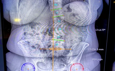 AI automated orthopedic measurements on the EOS load bearing X-ray system at RSNA 2023. Photo by Dave Fornell. #RSNA #RSNA23 #RSNA2023 orthopedic imaging