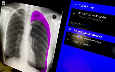 AI detected pneumothorax collapsed lung shown by Annalise at RSNA 2023. Photo by Dave Fornell. #RSNA #RSNA23 #RSNA2023