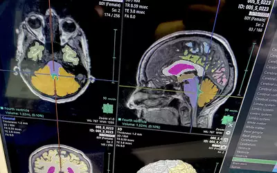 Brain MRI AI assessment and segmentation on Fujifilm's Synapse system at RSNA 2023. Photo by Dave Fornell. #RSNA #RSNA23 #RSNA2023
