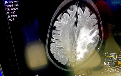 Brain CT scan showing glioblastoma brain cancer tumor. Tumors usually have much higher metabolism that normal tissues, so there is an increased uptake of contrast agents that enhance the tumor. Example on the Sectra PACS at RSNA 2023.  Photo by Dave Fornell #RSNA #RSNA23 #RSNA2023