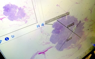 Example of a digital pathology breast specimen slides in the Sectra enterprise imaging system at RSNA 2023. Photo by Dave Fornell #RSNA #RSNA23 #RSNA2023 #Digitalpathology
