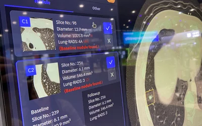 Automated Lung CT AI nodule detection and assessment, showing serial exams for a patient undergoiung therapy and the CT measurements used to see if the tumor is growing of shrinking. Vuno Med LungCT AI. Photo by Dave Fornell. #RSNA #RSNA23 #RSNA2023 orthopedic imaging