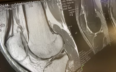 Knee MRI Canon Galan 3T RSNA23. Photo by Dave Fornell #MRI #RSNA