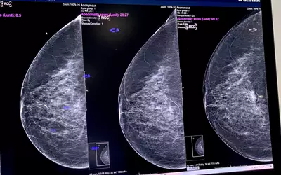 Lunit's mammography AI automated lesion detection with certainty score on shown on Sectra PACS platform. Photo by Dave Fornell. #RSNA #RSNA23 #RSNA2023