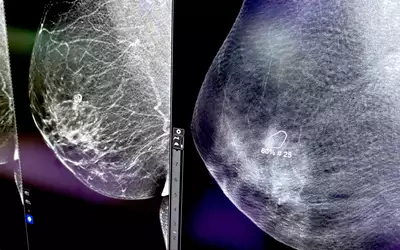 Mammography 2D and tomosynthesis 3D with cancer spotted by iCAD AI GE Pristina Bright RSNA23.