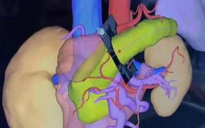 Pancreas CT image segmentation and assessment on the Fujifilm Synapse PACS at RSNA 2023. Photo by Dave Fornell. #RSNA #RSNA23 #RSNA2023 orthopedic imaging