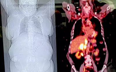 Example of the image quality for digital detector, time-of-flight PET-CT imaging of an adrenal mass in an obese cancer patient using the Siemens Biograph Vision X system. Photo by Dave Fornell. #RSNA #RSNA23 #RSNA2023