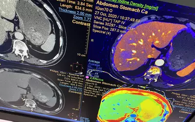 Spectral CT stomach cancer and liver iodine density and Z effective in Philips booth RSNA 2023. Photo by Dave Fornell. #RSNA #RSNA23 #RSNA2023