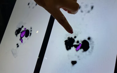 Theranostic for prostate cancer showing regression of tumor at Siemens booth RSNA 2023. Photo by Dave Fornell. #RSNA #RSNA23 #RSNA2023