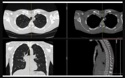Soldier's chest CT showing shrapnel that torn through the Trachea and esophagus at a hospital in Vinnystіa. Photo by Oksana Gusar, courtesy of RSNA. https://www.rsna.org/news/2023/june/oksana-gusar