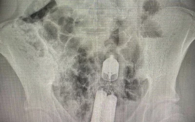 Vibrator retained in colon after a teenager inserted it into their rectum. Okhmatdyt Children's Hospital in Kyiv, Ukraine, posted this with other images as a public service message on social media post because the hospital removes these types of items on a regular basis. Courtesy of Okhmatdyt Children's Hospital. Sex toy vibrator stuck in the rectum.
