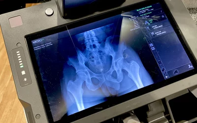 MicroX Rover cold cathode mobile X-system with image of pevis hips RSNA 2024. 