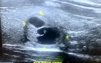 Follow-up Sagittal ultrasound image of the same benign nodule measuring 2 cm. This complex solid and cystic lesion is a Thyroid Imaging Reporting and Data System (TI-RADS) 3 nodule, which was recommended for ultrasound followup at 12 months for monitoring. Images used with patient permission. 