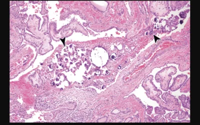 Pathology microscope image of biopsy showing thyroid papillary carcinoma in a 13-year-old female adolescent. High-power photomicrograph shows the classic type of papillary thyroid carcinoma, with central psammomatous calcifications (arrowheads). (H-E stain; original magnification, x100). RSNA image