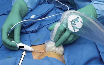 Intraprocedural image showing use of ultrasound to guide a radio frequency ablation electrode (arrow) to the thyroid in a 33-year-old woman with a benign (two negative FNAs) right thyroid lobe nodule that was producing compressive symptoms. The patient lies supine with the neck extended and general anesthesia is often used. Image courtesy of RSNA.