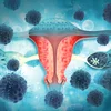 ovaries ovarian cancer