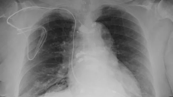 Chest MRI