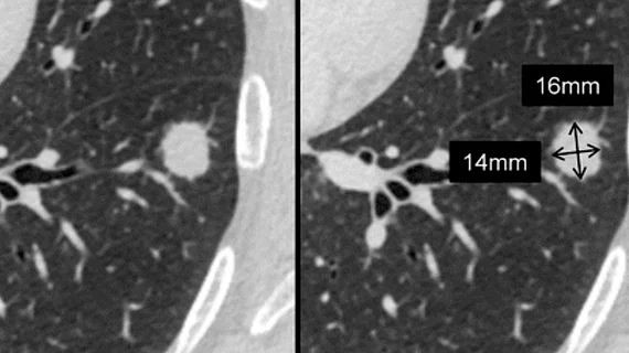 CT scan showing lung cancer nodules with measurements of each nodule to track growth or regression from treatment. Image courtesy of RSNA