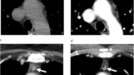 enlarged parathyroid gland